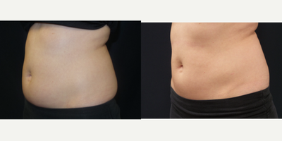 SculpSure before and after photo