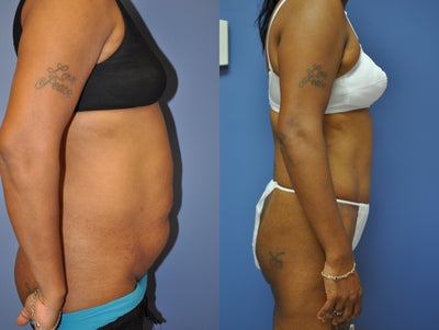 Tummy Tuck before and after photo