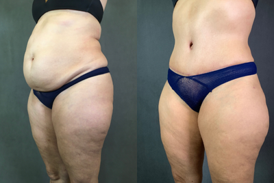 Tummy Tuck before and after photo