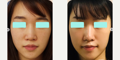 Asian Rhinoplasty before and after photo