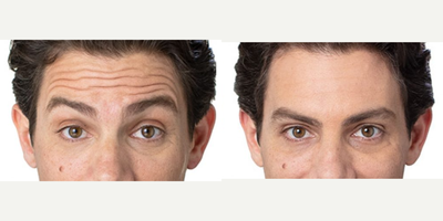 Botox before and after photo