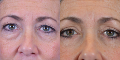 Eyelid Surgery before and after photo