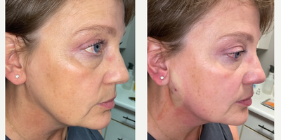 Nonsurgical Facelift before and after photo