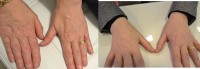 Radiesse before and after photo