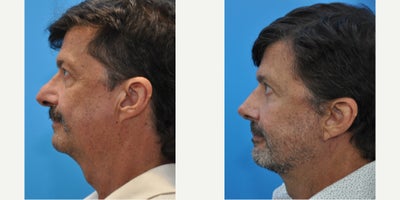 Eyelid Surgery before and after photo