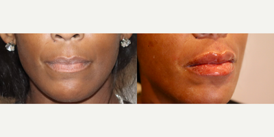 Lip Fillers before and after photo