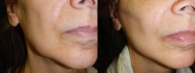 Mini Facelift before and after photo