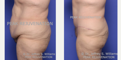 Tummy Tuck before and after photo