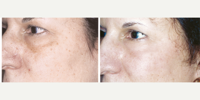 Laser Resurfacing before and after photo