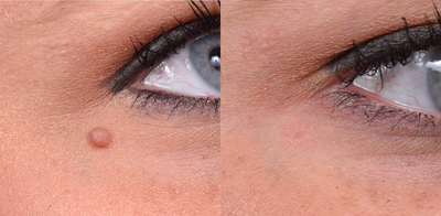 Mole Removal before and after photo