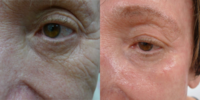 CO2 Laser before and after photo