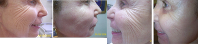 Fraxel Repair before and after photo