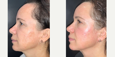 NeoGen Plasma before and after photo