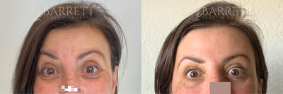 Botox before and after photo