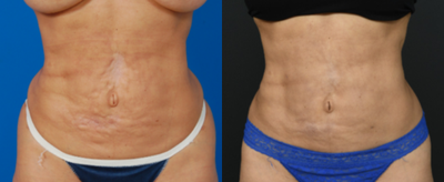 Liposuction Revision before and after photo