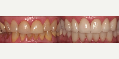 Porcelain Veneers before and after photo