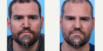 Rhinoplasty before and after photo