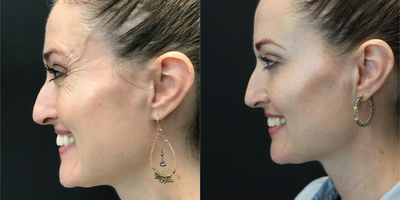 Botox before and after photo