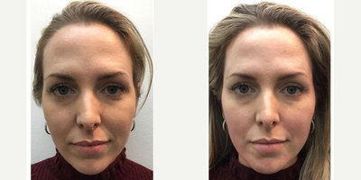 Bellafill before and after photo