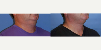 CoolMini before and after photo
