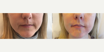 Dermal Fillers before and after photo