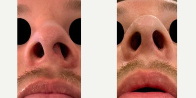 Septoplasty before and after photo