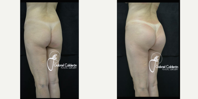 Butt Implants before and after photo
