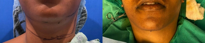 Chin Liposuction before and after photo