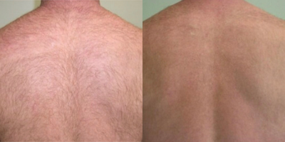 Laser Hair Removal before and after photo