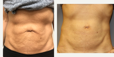 Microneedling before and after photo