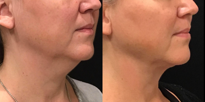 Renuvion before and after photo