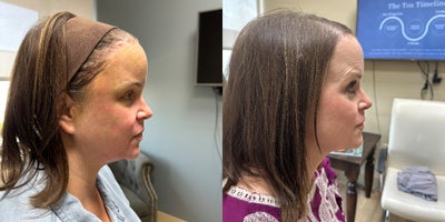 CO2 Laser before and after photo