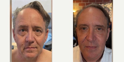 Facelift before and after photo