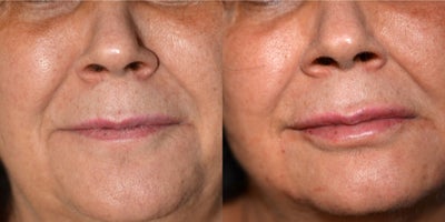 Lip Fillers before and after photo