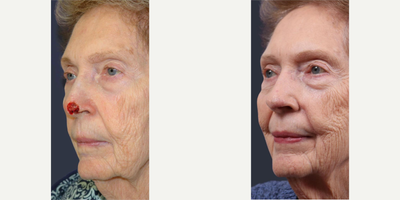 Mohs Surgery before and after photo