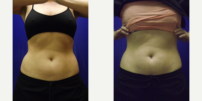 SculpSure before and after photo