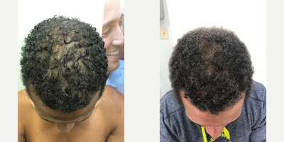 ALMI before and after photo