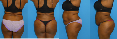 Brazilian Butt Lift before and after photo