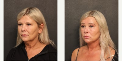 Facelift before and after photo