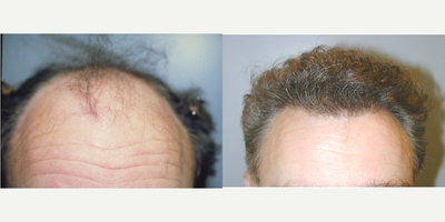 NeoGraft before and after photo