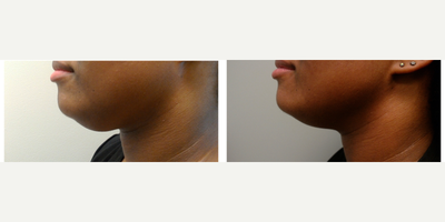 Kybella before and after photo