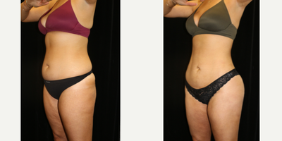 Liposuction before and after photo