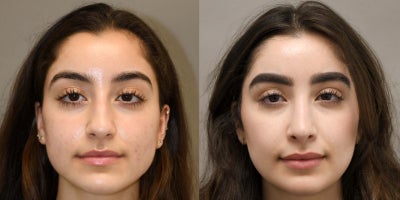 Rhinoplasty before and after photo