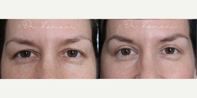 Eyelid Surgery before and after photo
