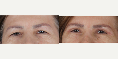 Eyelid Surgery before and after photo