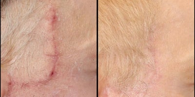 Laser Resurfacing before and after photo