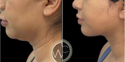 Neck Lift before and after photo