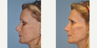 Revision Rhinoplasty before and after photo