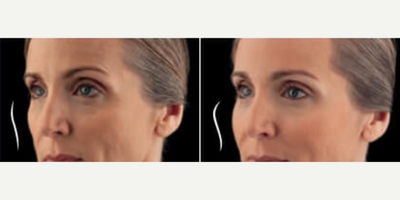 Voluma before and after photo