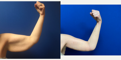 Arm Lift before and after photo